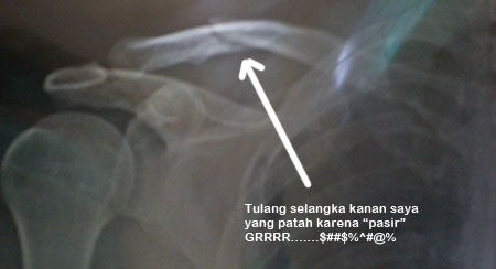 Gejalah patah tulang selangka kanan