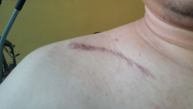 Bekas operasi cabut pen bahu kanan