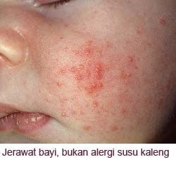 Jerawat bayi di pipi dan dagu