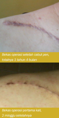 Foto perbandingan bekas operasi selama 1 tahun