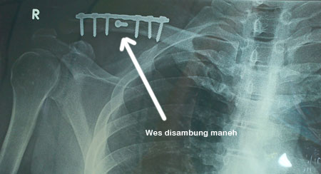 Foto rongen patah tulang selangka